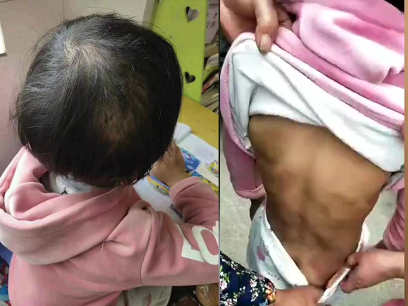 9歲女童遭祖母家暴,全身多處瘀青,頭髮被扯掉。(網圖)