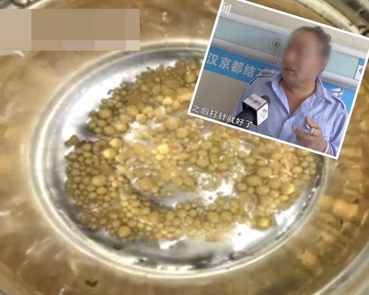 鄧男體內共取出612粒結石。