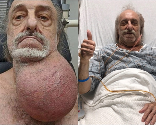 頸部腫瘤如足球般大 81歲老翁經7小時手術成功切除