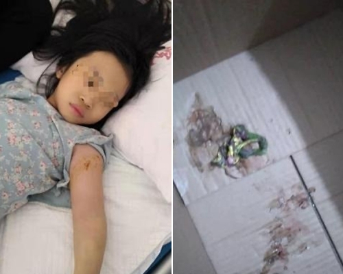 不是玩具!福建7歲女童手伸玩具箱不慎被蛇咬傷