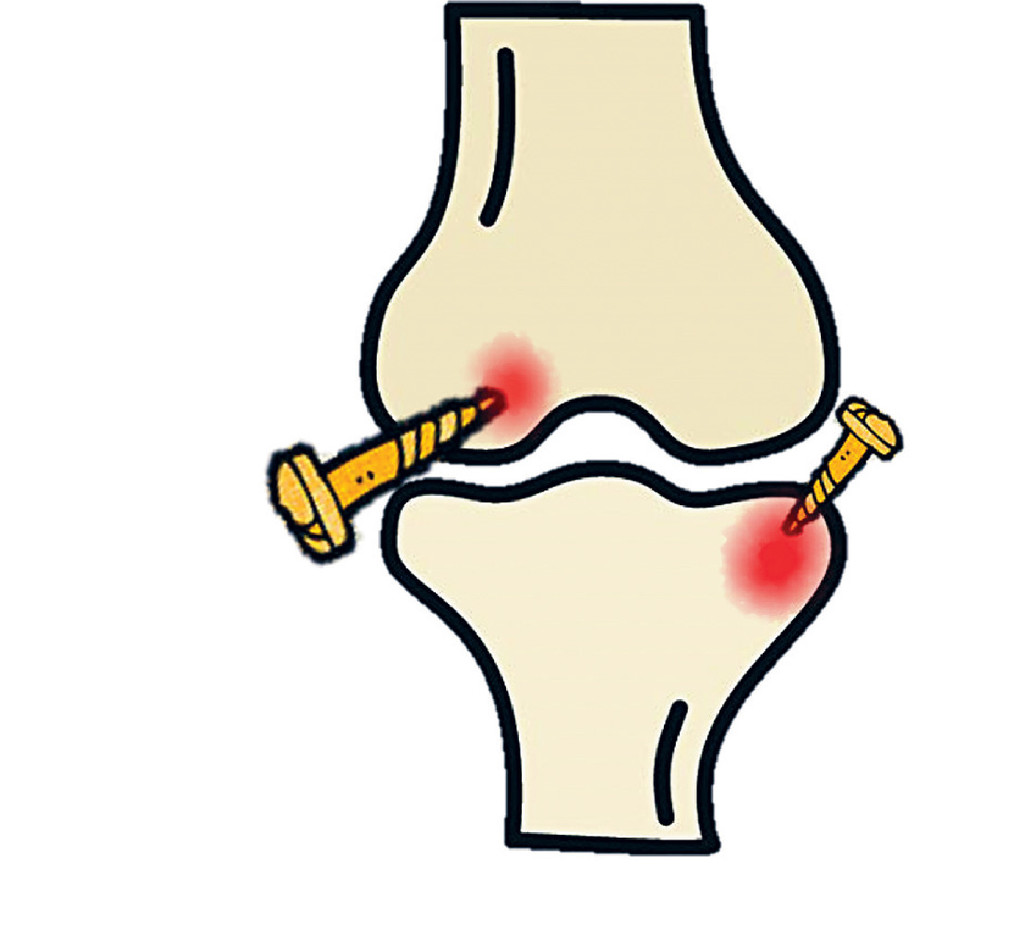 ■退化性關節炎主要在膝關節、腰背和腳部，間中手指亦會發生，病徵多為疼痛、腫脹和行動不便。