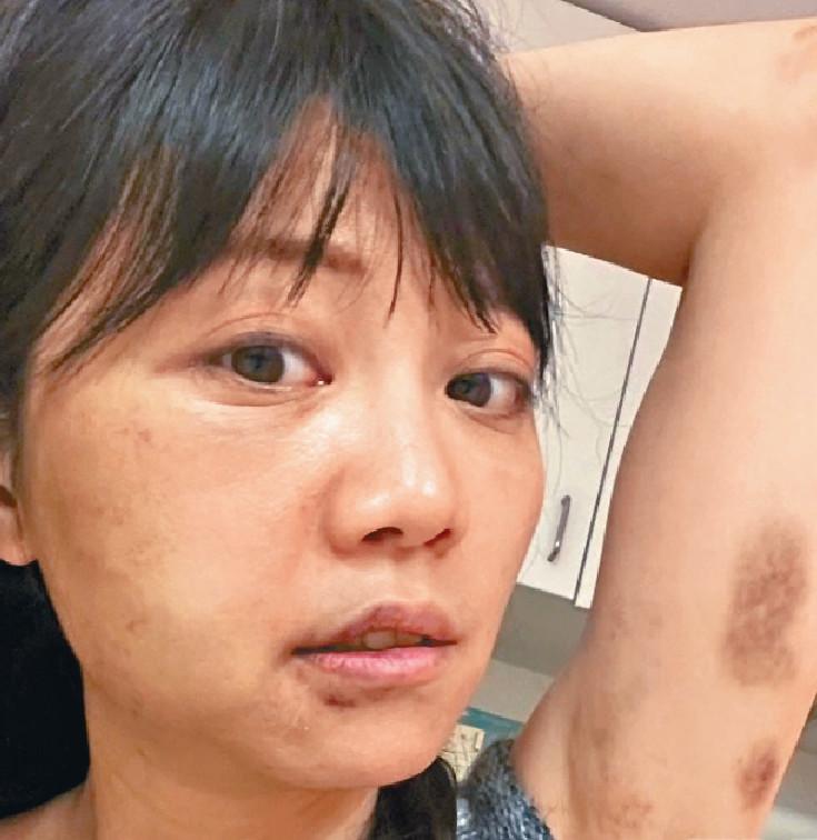 ■高嘉瑜向台媒提供的照片顯示，她被施暴後傷勢嚴重，臉部破相。網上圖片