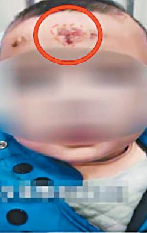 ■女嬰額頭上有明顯剮蹭後的皮疹。網上圖片
