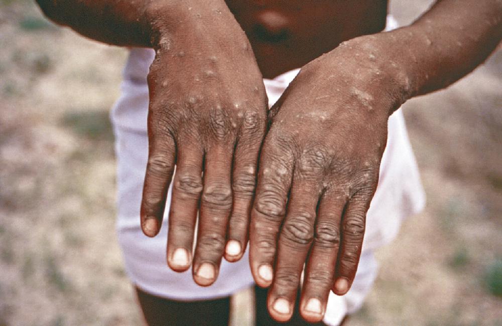 ■感染猴痘患者會出現皮疹。資料圖片