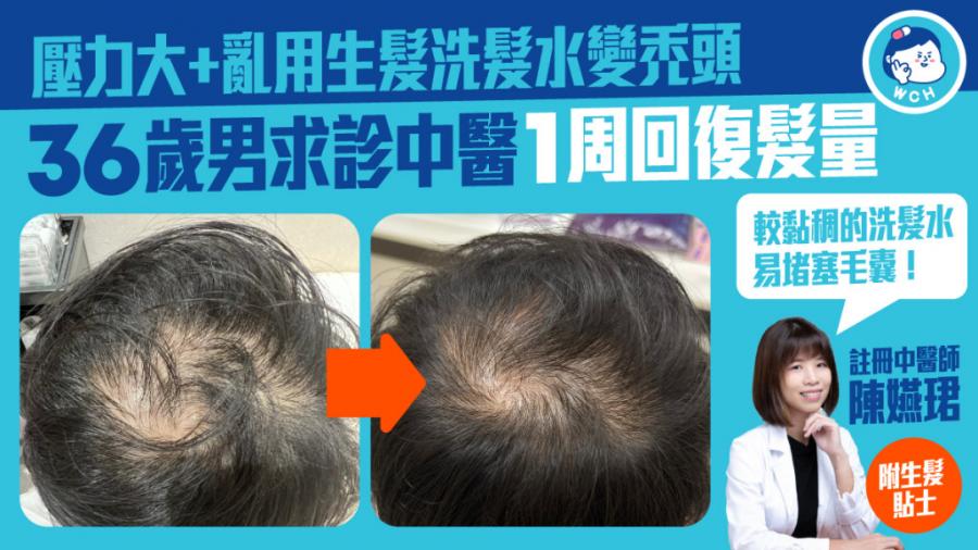 脫髮｜壓力大亂用生髮洗髮水變禿頭 36歲男求診中醫1周回復髮量（附食療）