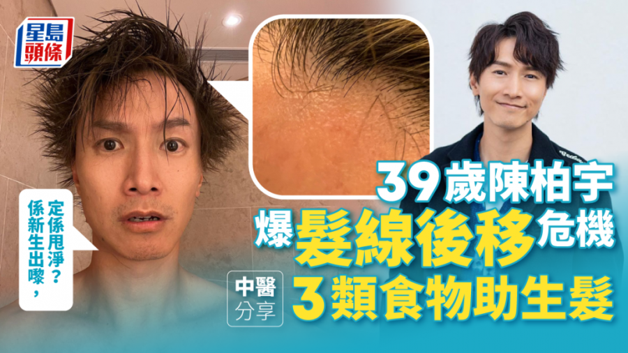 脫髮｜39歲陳柏宇爆髮線後移危機 中醫分享3類食物助生髮 (附食療)